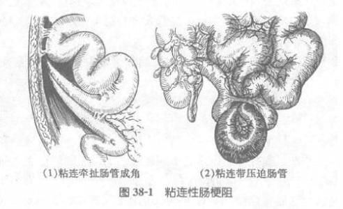 手术后肠粘连是什么症状和表现用中医来解释