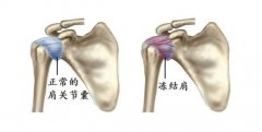 肩关节周围炎是什么症状和表现用中医来解释