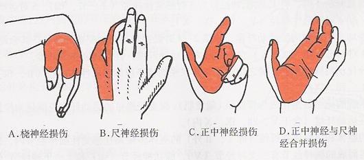 正中神经损伤是什么症状和表现用中医来解释
