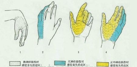 正尺神经损伤是什么症状和表现用中医来解释