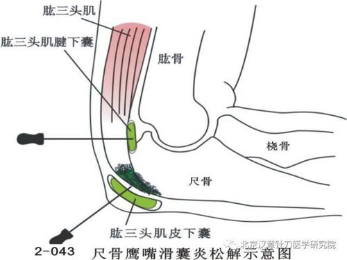 鹰嘴后滑囊炎是什么症状和表现用中医来解释