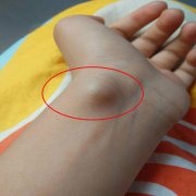 腱鞘囊肿是什么症状和表现用中医来解释