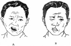眼睑痉挛是什么症状和表现用中医来解释
