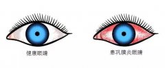 巩膜炎是什么症状和表现用中医来解释