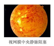 视网膜中央静脉阻塞是什么症状和表现用中医来解释