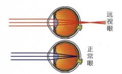 远视眼是什么症状和表现用中医来解释