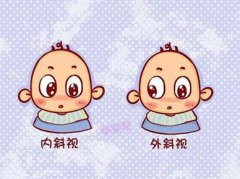 斜视是什么症状和表现用中医来解释