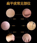 扁平疣是什么症状和表现用中医来解释