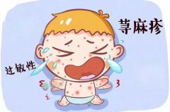 荨麻疹是什么症状和表现用中医来解释