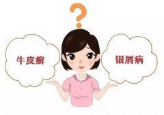 银屑病是什么症状和表现用中医来解释