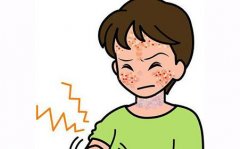 神经性皮炎是什么症状和表现用中医来解释