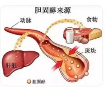 胆固醇与动脉粥样硬化有什么关系?它有哪些生理功用?