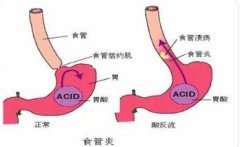 食管癌为什么会引起咽下困难?