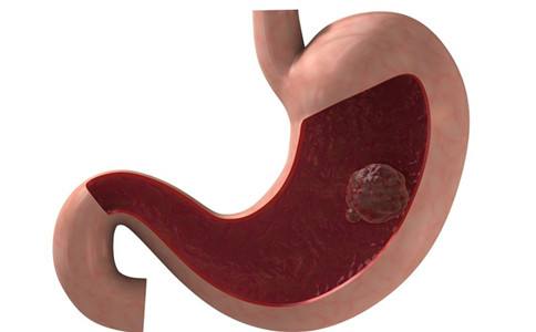 消化性胃溃疡如何治疗