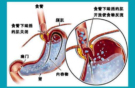 反流性食管炎怎么治疗