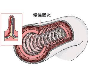 慢性结肠炎