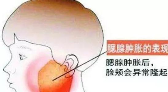 流行性腮腺炎的治疗-小柴胡加石膏汤