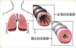 急性支气管炎