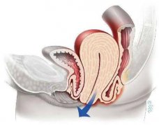 直肠脱垂(脱肛)是什么症状和表现用中医来解释