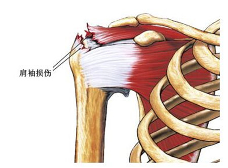 三角肌劳损是什么症状和表现用中医来解释