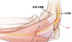 肘管综合征是什么症状和表现用中医来解释