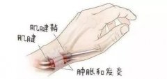 拇长屈肌肌腱腱鞘炎（扳机指）是什么症状和表现用中医来解释