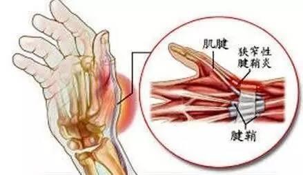 手2、3、4、5指屈肌肌腱腱鞘炎是什么症状和表现用中医来解释
