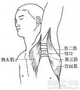 肋锁综合征是什么症状和表现用中医来解释