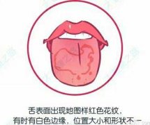 舌炎是什么症状和表现用中医来解释
