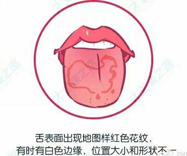 舌炎是什么症状和表现用中医来解释