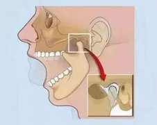 颞颌关节炎是什么症状和表现用中医来解释