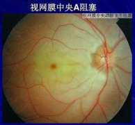 视网膜中央动脉阻塞是什么症状和表现用中医来解释