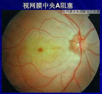 视网膜中央动脉阻塞是什么症状和表现用中医来解释