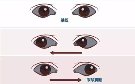 眼肌麻痹是什么症状和表现用中医来解释