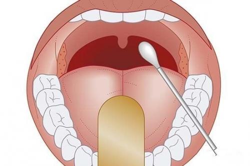 扁桃体炎的症状