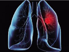 肺结核的症状和表现_肺结核治疗