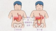 胃下垂的症状_胃下垂吃什么药
