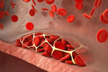 什么是血栓?促使血栓形成的因素有哪些?
