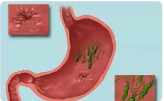 胃、十二指肠溃疡病是怎样发生的?