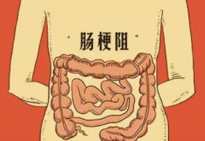 肠梗阻是怎样发生的?