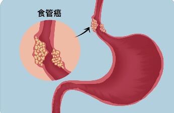 食管疾病预防方法有哪些_食管癌预防和治疗方法